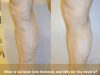 What is Varicose Vein Removal, and Why Do You Need it?